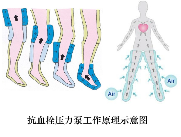 抗血栓压力泵工作原理